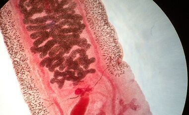 Anquilostomose en humanos