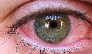 as razóns da aparición de parasitos nos ollos dos humanos